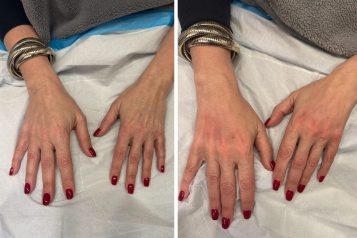 The Five Treatment Options To Combat Ozempic Hands