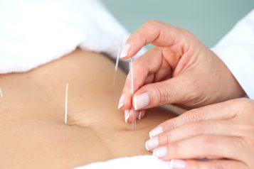 Doctor,Performing,An,Abdominal,Acupuncture,Procedure,On,A,Female,Patient