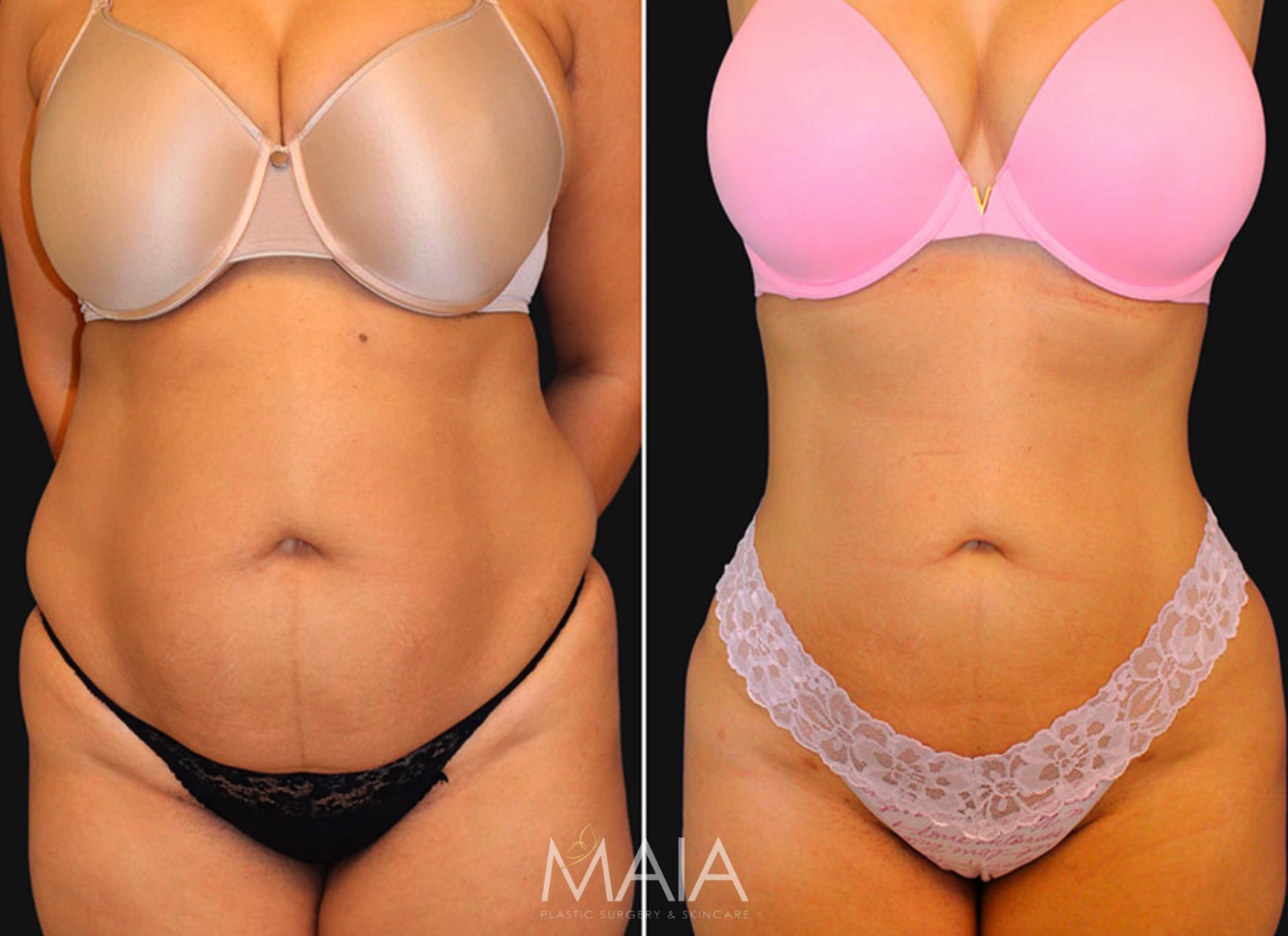 Learn the Difference Between BodyTite and Tummy Tuck