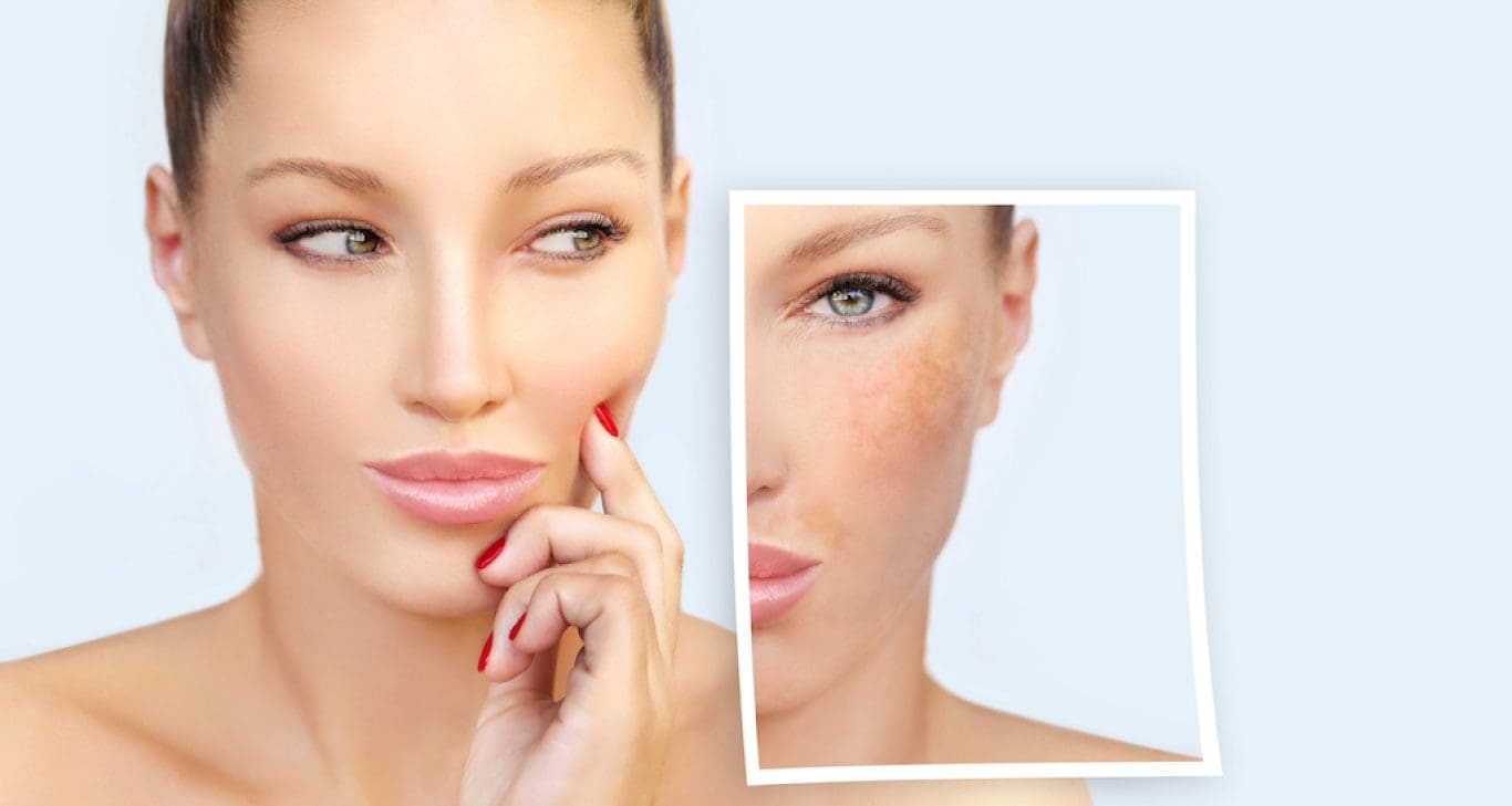 If You're On A Quest For Perfect Skin The QSwitched Laser Beckons You