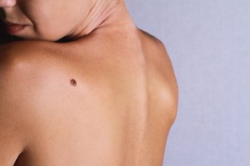 Laser-Powered Mole Removal: Your Path To A Safe And Scarless Solution