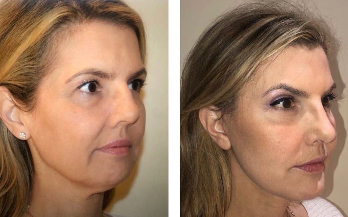Revealing Confidence Why Plastic Surgery Knows No Season Haute