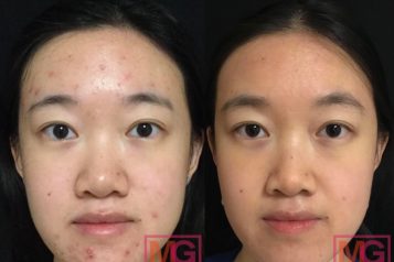 JZ-25-F-before-and-after-6-months-of-Accutane-FRONT-MGWatermark-1