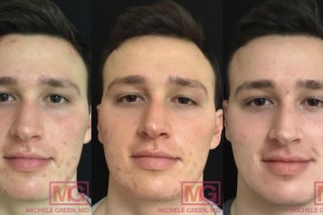 MG-19-before-after-accutane-acne-1-to-5months-MGWatermark