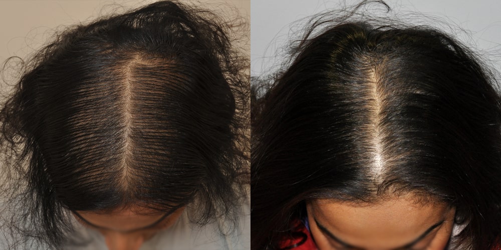 Before and after photos of a scalp showing the results of PRP treatments for hair loss. The 'before' image on the left displays a parting down the middle of the head with noticeable thinning and a wider gap exposing the scalp. The 'after' image on the right shows the same parting but with significantly denser hair growth and less scalp visibility, indicating a successful response to the PRP therapy.