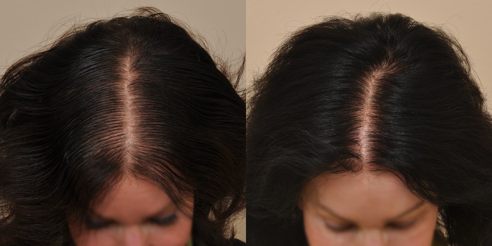 Side-by-side comparison of before and after photos depicting the scalp of a patient treated with PRP therapy for hair restoration. The left image shows the initial state with a prominent parting and sparse hair density, making the scalp quite visible. The right image, taken after the treatment, reveals a much fuller hair density with the parting appearing narrower and less scalp showing through, demonstrating the effectiveness of the treatment.