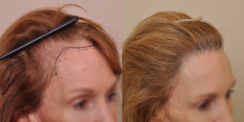 Before and after images showcasing the transformation achieved through two linear hair restoration surgeries performed by Dr. Ken Anderson in Atlanta, GA. In the 'before' photo on the left, a comb lifts hair to reveal a marked area on the scalp with significant hair loss along the hairline, demarcated for treatment. The 'after' photo on the right displays the same region with dramatically improved hair coverage, a fuller hairline, and no visible marking, reflecting the successful outcome of the surgeries.