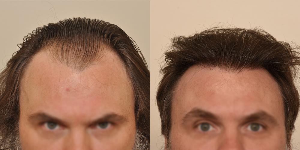 The image shows a side-by-side comparison of a man before and after hair treatment achieved through a linear hair restoration surgery performed by Dr. Ken Anderson at the Anderson Center for Hair. On the left, his hair is thinning significantly at the top, revealing a thinning front patch and a significantly receding hairline. On the right, after treatment, his hair appears fuller with a much-reduced bald patch and a denser, more youthful hairline. The photos focus closely on his forehead and hair, emphasizing the changes in hair density and coverage.