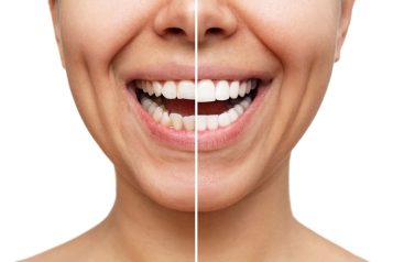 Why Porcelain Veneers Are The Go-To Choice For A Stunning Smile