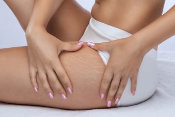 Avéli: The Revolutionary Treatment For Cellulite