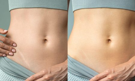 Fraxel® and Vbeam®