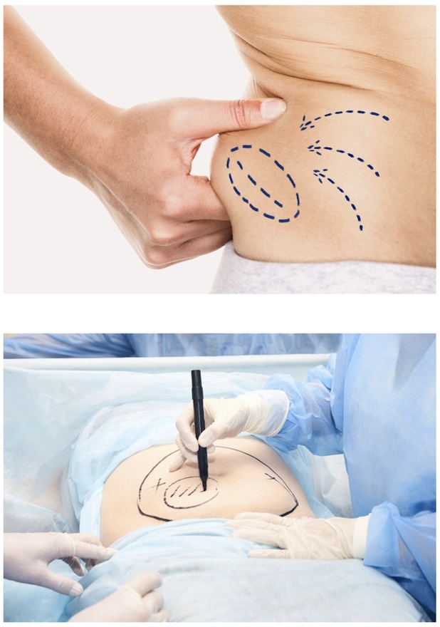 Abdominoplasty
