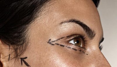 Global Facelift Expert - deep plane facelift