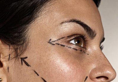 Global Facelift Expert - deep plane facelift