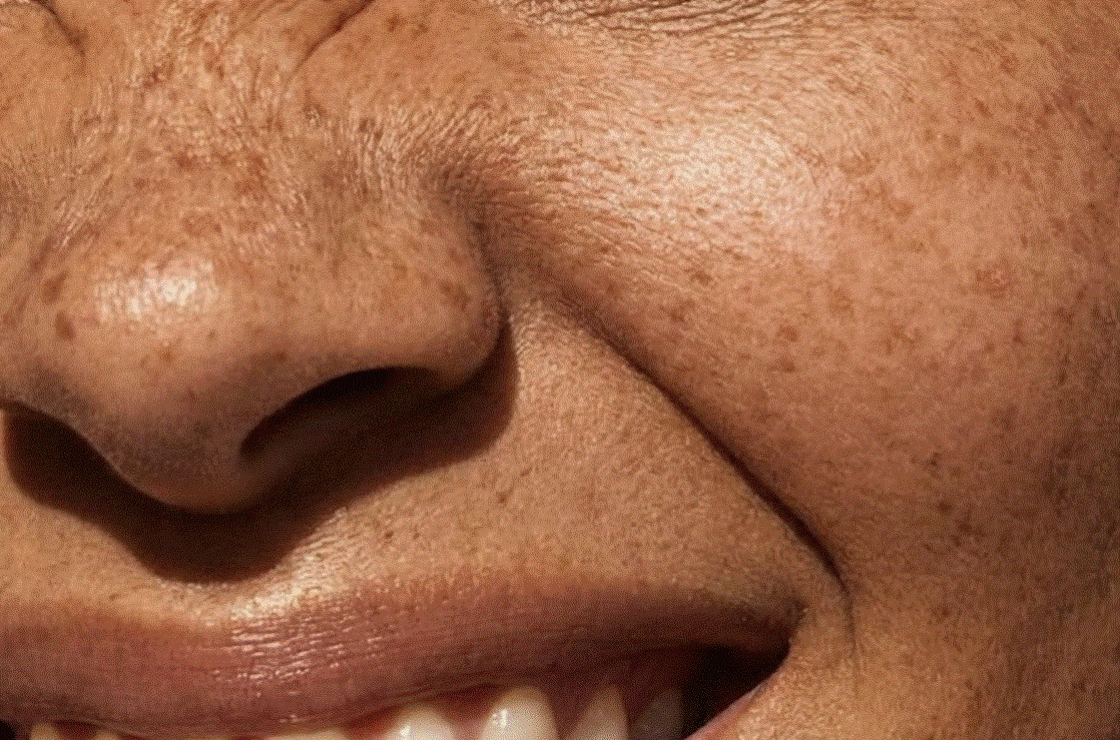women smile closeup - TMJ treatment
