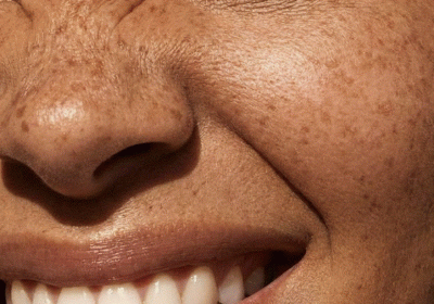 women smile closeup - TMJ treatment