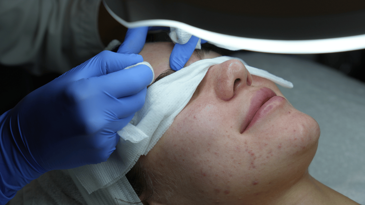 Acne Triggers You Never Knew Affecting Your Skin