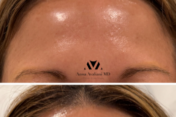 forehead filler