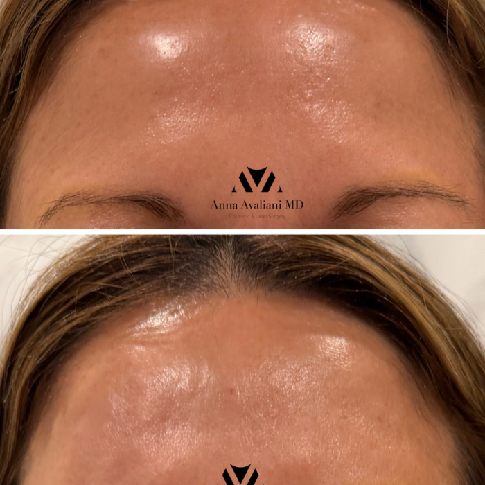 From Hollow to Harmonious: How Forehead Filler Can Transform Facial Balance