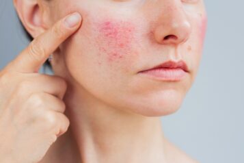 Young,Caucasian,Woman,Suffering,From,Rosacea,On,Her,Face,In