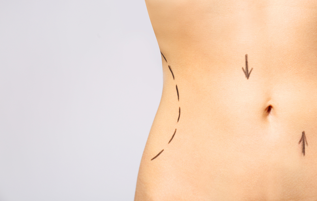 CoolSculpting® New York City’s Go-To For Body Contouring