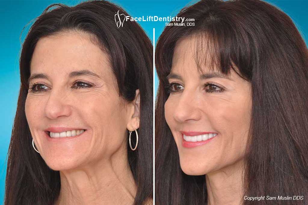 non-surgical facelift