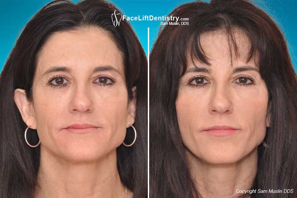 Facelift dentistry