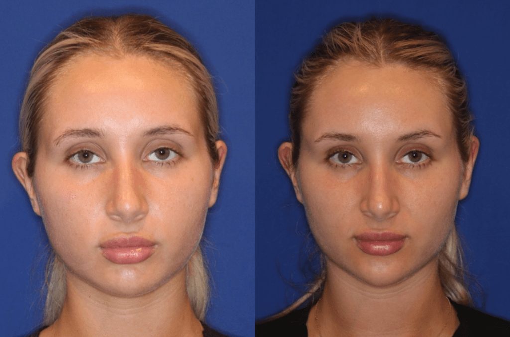 EVOKE FACE SKIN TIGHTENING – Dr. Jennifer Levine