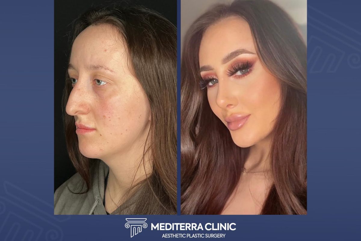 From Istanbul To The World: The Global Impact Of Mediterra Clinic’s Approach In Rhinoplasty