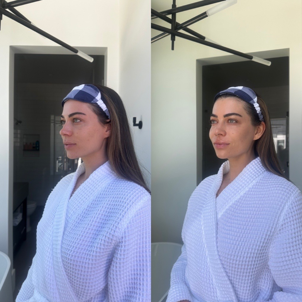 Glass Skin’s Magic Wand treatment, a non-invasive laser facial with immediate results and zero downtime